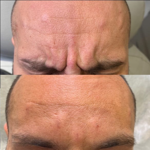 korekcja zmarszczek wrocław