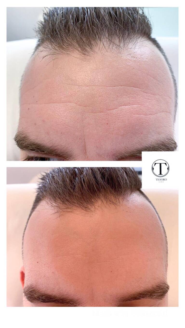 botox - czoło wrocław