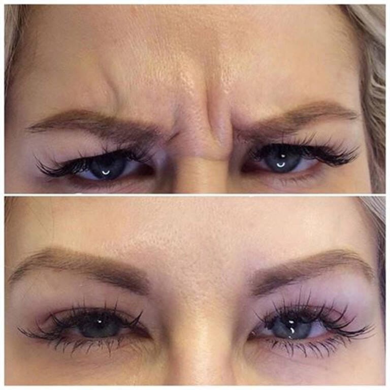 Botoks lwia zmarszczka