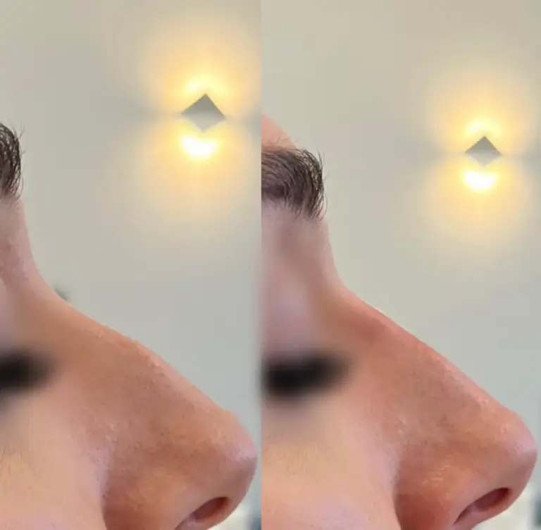 Korekta nosa kwasem hialuronowym tesoro clinic