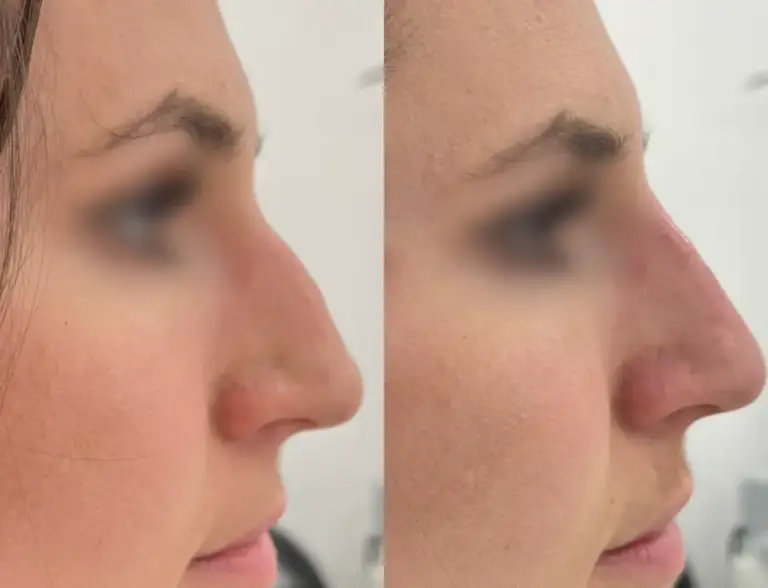 Korekta nosa kwasem hialuronowym tesoro efekty opinie