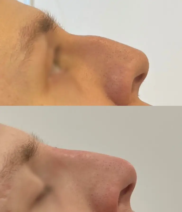 Korekta nosa kwasem hialuronowym tesoro wrocław