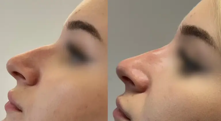 Korekta nosa kwasem hialuronowym wrocław tesoro