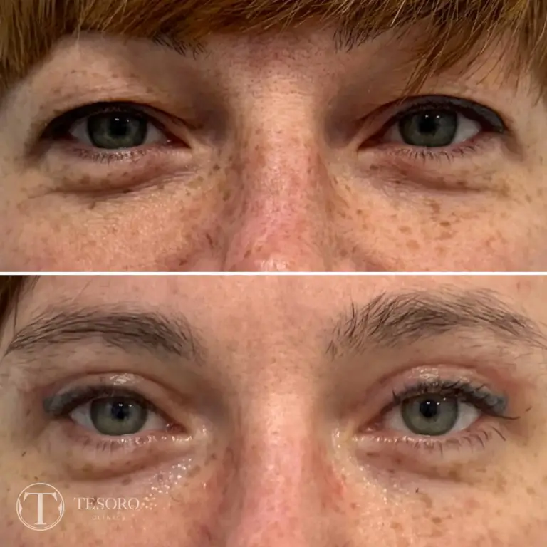 plastyka-powiek-wrocław-tesoro-clinic-05
