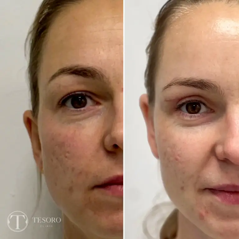 plastyka-powiek-wrocław-tesoro-clinic-10