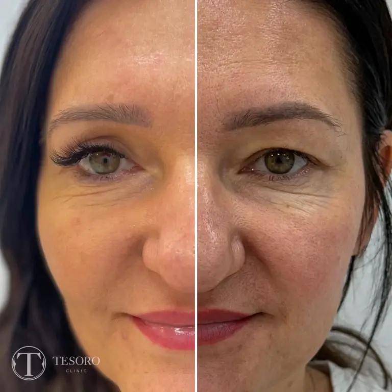 plastyka-powiek-wrocław-tesoro-clinic-26