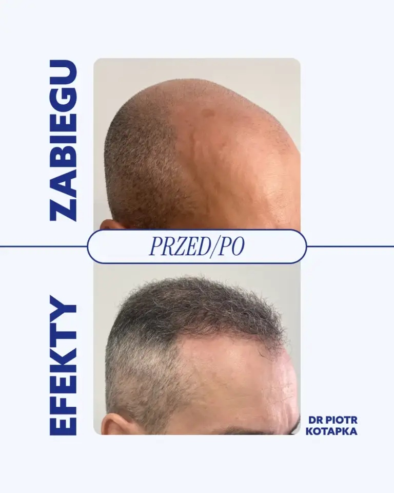 przeszczep-włosów-tesoro-clinic