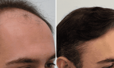 przeszczep-wlosow-metoda-fue