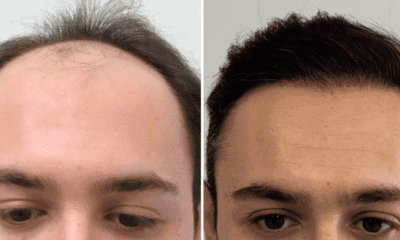 transplantacja-wlosow-efekty-wroclaw