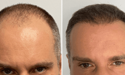 udany-przeszczep-efekty-fue-wroclaw