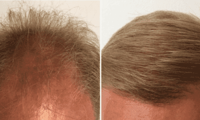 geste-wlosy-po-przeszczepie-fue