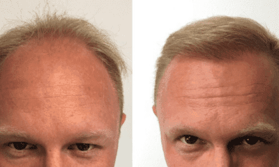 przeszczep-efekty-wlosy