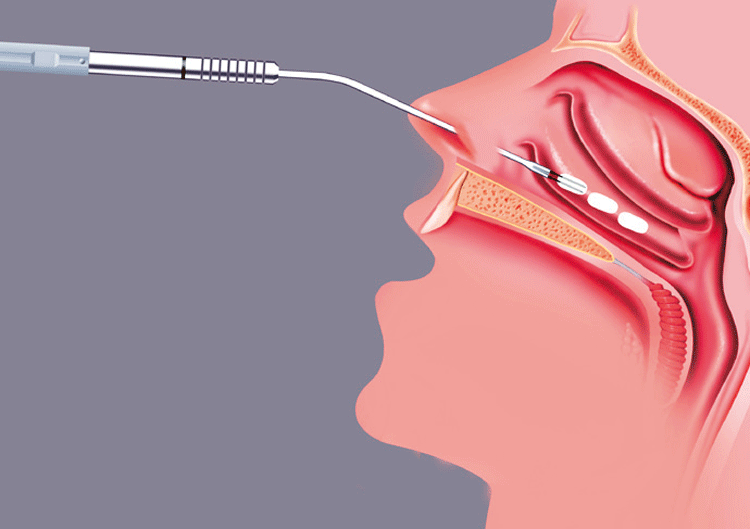 Ablacja-małżowin-nosowych-kobblacja-konchoplastyka-wrocław