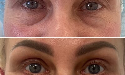 laserowa korekcja powiek