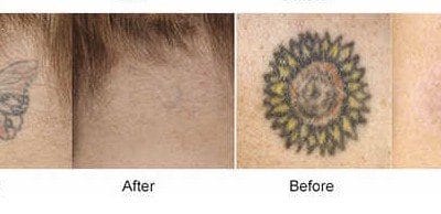 usuwanie tatuażu laserem