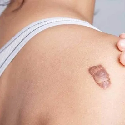 Leczenie-blizn-Wrocław