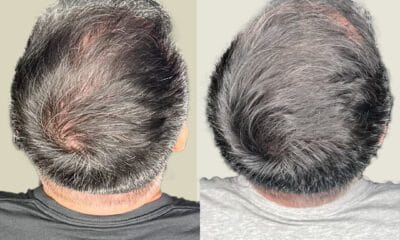 Mikropigmentacja skóry głowy wrocław - 7