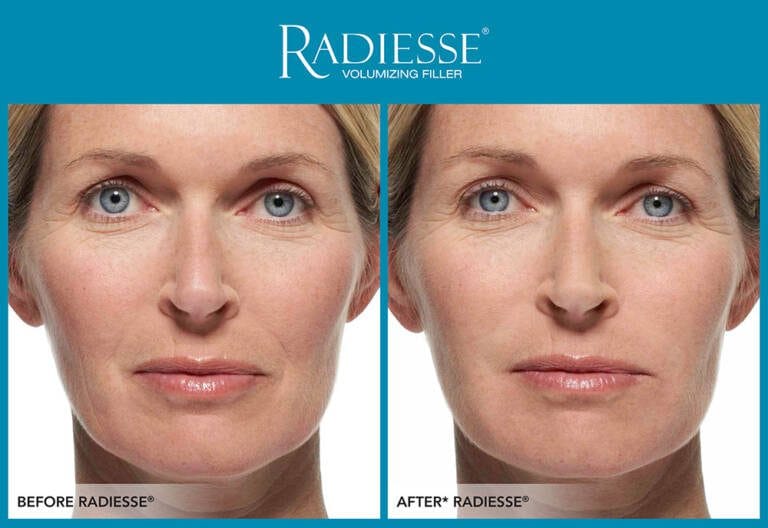 RADIESSE-WROCŁAW
