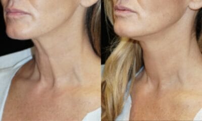 Renuvion J plasma wroclaw efekty6