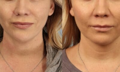 Renuvion J plasma wroclaw efekty9