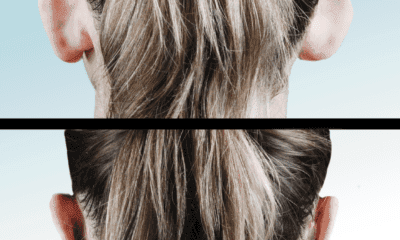 chirurgiczna korekta uszu