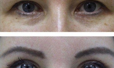 chirurgiczna korekcja powiek