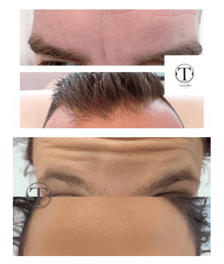 botoks na czoło w klinice Tesoro Clinic we Wrocławiu