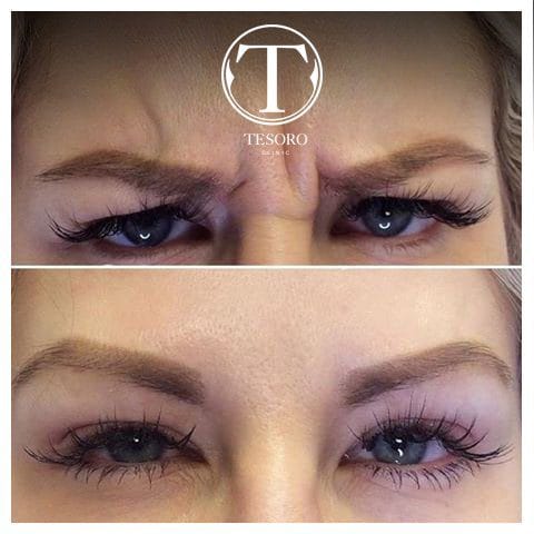 botoks na czoło przed i po