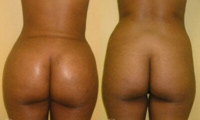 efekty-powiekszania-posladkow-wroclaw