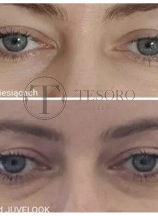 Efekty zabiegu Juvelook