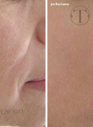 karisma-biostymulator-wroclaw-324x443