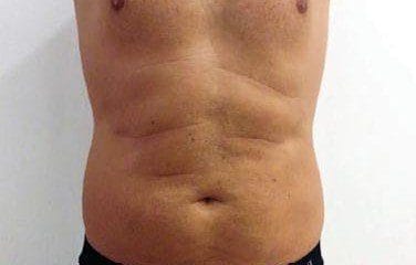 kriolipoliza cooltech przed zabiegiem