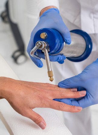 laserowe usuwanie kurzajek alternatywa dla wymrażania