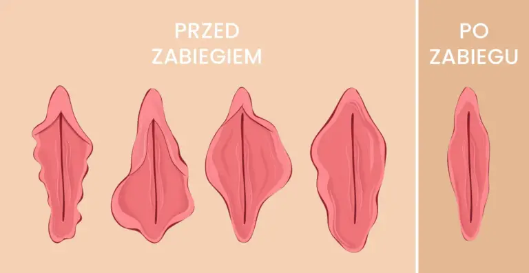 labioplastyka-tesoro-wrocław