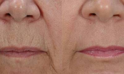 laserfrakcyjny_02-mu5fb5z5a757pb3ljha6jrlk1xzpfontthf7jw3zfw