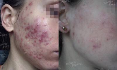 laserfrakcyjny_03-mu5b1cnwx6l1ugiuphqz12x4l24eur13069teu67n0