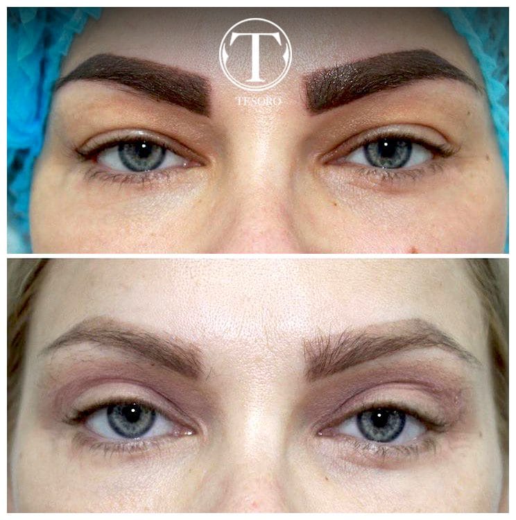 Laserowy lifting powiek