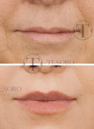 lip-lift-bullhorn-lip-lift-modelowanie-gornej-wargi-324x443