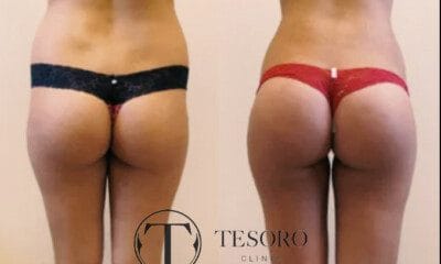 lipomodelling-posladkow-efekty