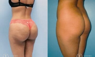 lipomodelling-posladkow-zabieg-1