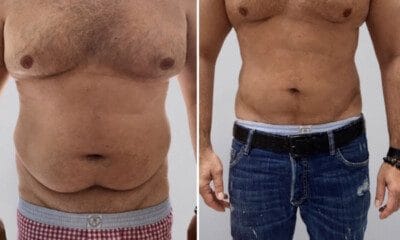 liporzezbienie-ciała-vaser-lipo-4d