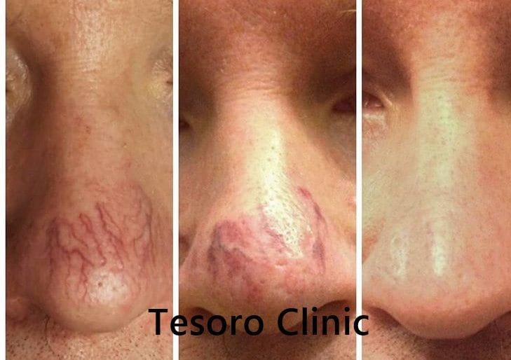 laserowe usuwanie naczynek Wrocław