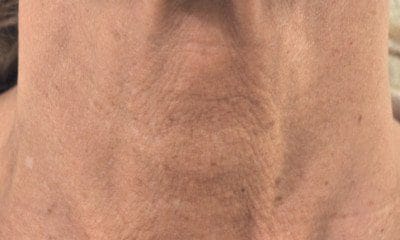 piersini_szyja_przed_profhilo