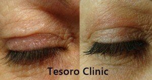 plasma iq na powieki Wrocław Tesoro Clinic