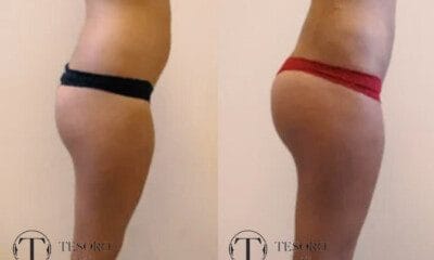 powiekszanie-posladkow-wlasnym-tluszczem