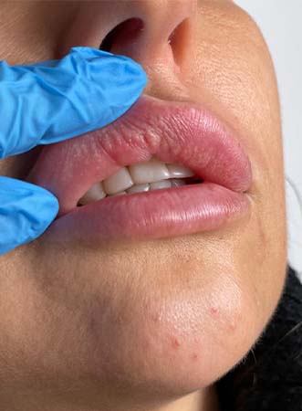 powikłania-przy-powiększaniu-ust-rozpuszczanie-ust-wroclaw