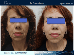 ultraformer wrocław