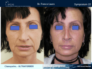 ultraformer wrocław