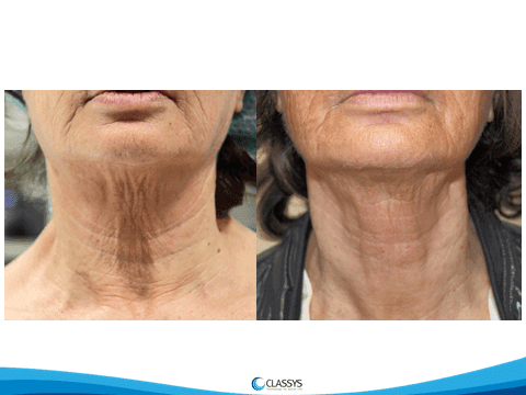 ultraformer wrocław