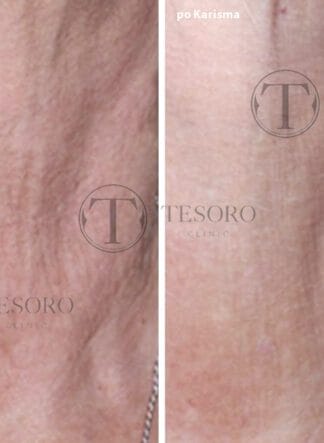 Karisma biostymulator efekty